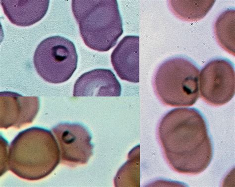  Plasmodium! An Insidious Parasite Lurking Within Your Blood